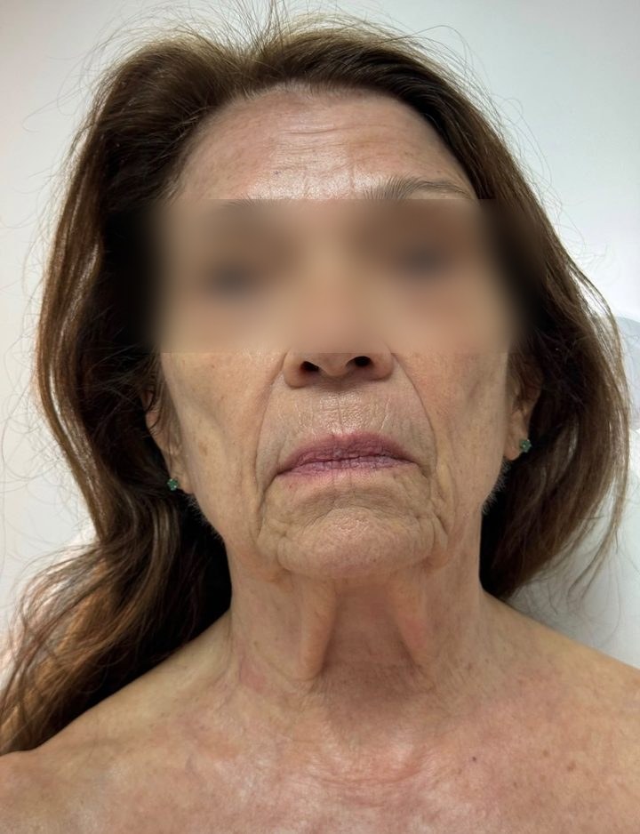 The same client after the LED and Cryo Face and Neck Lift