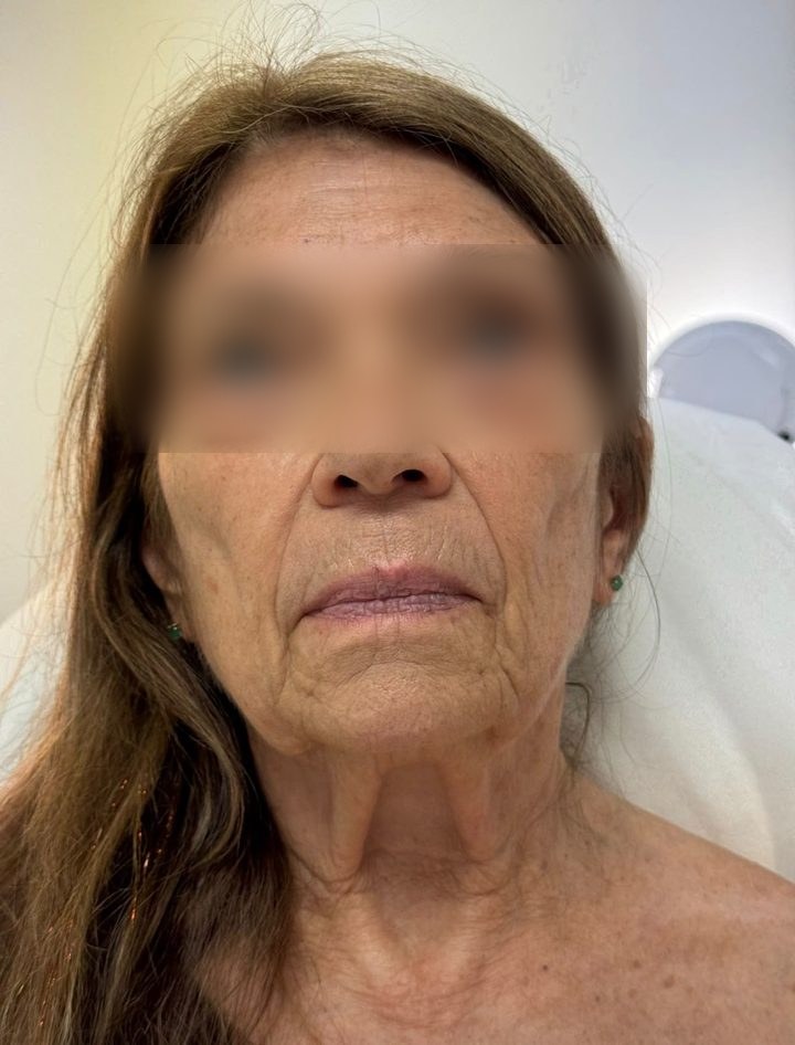 Client before the LED and Cryo Face and Neck Lift